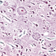 Imagen histopatológica de placas seniles vista en la corteza cerebral de un paciente con la enfermedad de Alzheimer.